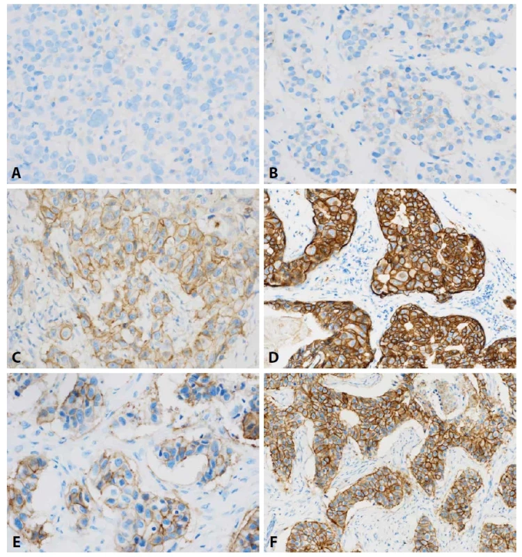 Imunohistochemický průkaz HER-2 proteinu. A. Kompletní negativita. B. Slabá pozitivita. C. Středně silná kompletní pozitivita. D. Silná kompletní pozitivita. E, F. Výsledek IHC při nedodržení podmínek preanalytické fáze (dlouhý čas studené ischemie; je zřetelná heterogenita i snížená intenzita barvení srovnej s D). E. Oblasti hůře fixované. F. Oblasti s lepší fixací. Barveno IHC anti-HER-2, originální zvětšení 400x.