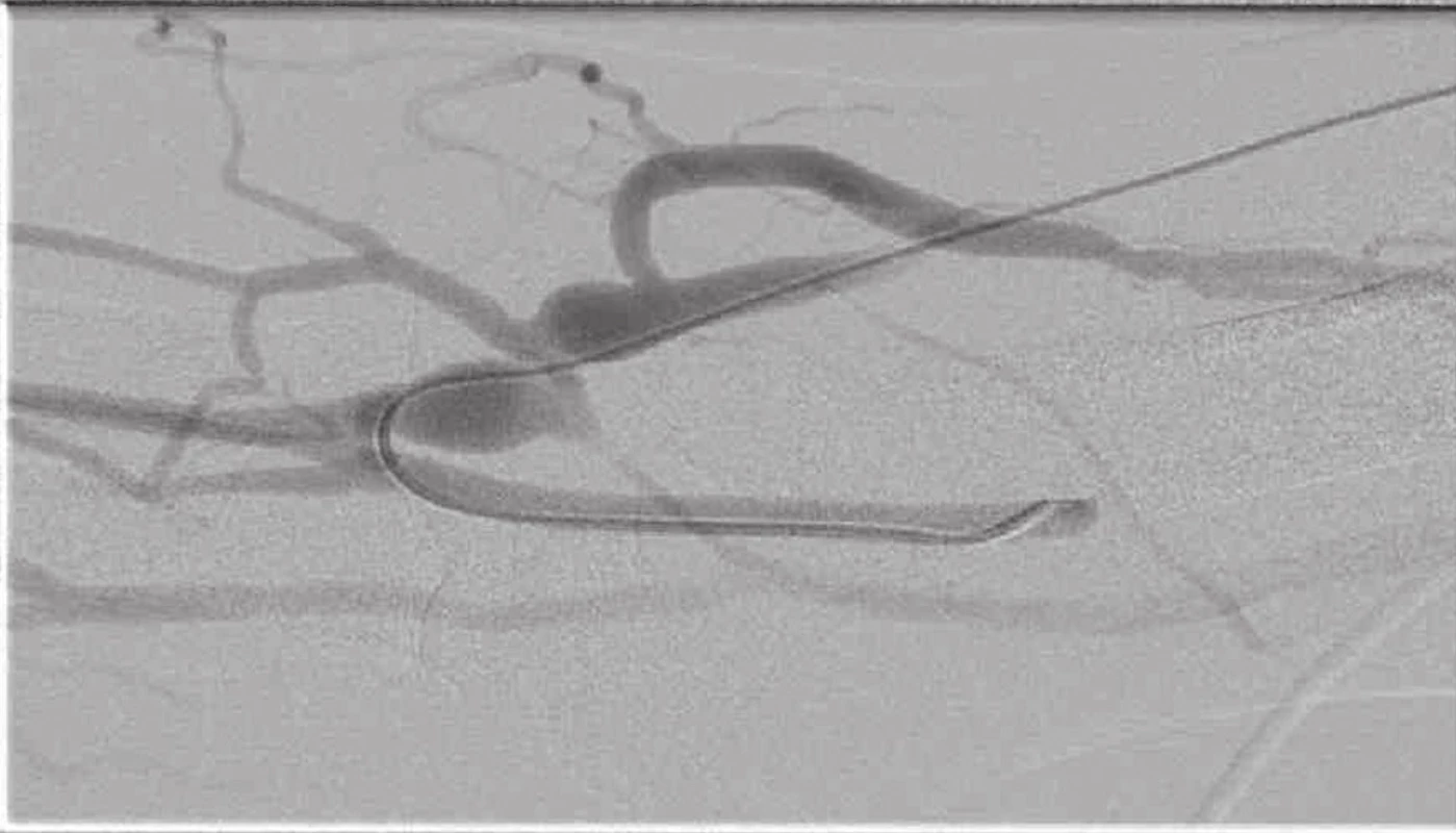 Fistulografie s těsnou stenózou na odvodné žíle a přítomnými kolaterálami
Fig. 9: Fistulogram showing a tight stenosis in the main vein and the presence of collateral veins