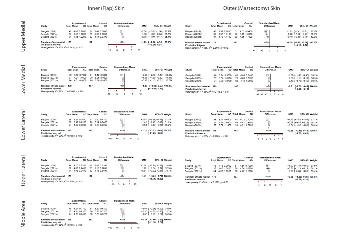 Forest plot for pooled standardized mean diff erence (SMD) for overall SMWT rod size between breasts with endto- end nerve coaptation against no surgical reinnervation. Signifi cant diff erence was only seen in the upper medial section of outer (mastectomy) skin (SMD −0.74, 95% CI −1.42; −0.06). Pooled SMD in SMWT rod size was generally higher in outer (mastectomy) skin, albeit insignifi cant: −0.81 (95% CI −2.05; 0.44) for lower medial, −0.85 (95% CI −2.10; 0.41) for lower lateral, and −0.65 (95% CI −1.56; 0.26) for upper lateral sections. Pooled SMD in SMWT rod size for inner (fl ap) skin was found to be −1.29 (95% CI −2.94; 0.36) for upper medial, −1.28 (95% CI −2.84; 0.27) for lower medial, −1.32 (95% CI −3.13; 0.48) for lower lateral, −1.41 (95% CI −3.61; 0.79) for upper lateral, and −1.34 (95% CI −3.09; 0.42) for nipple section.
