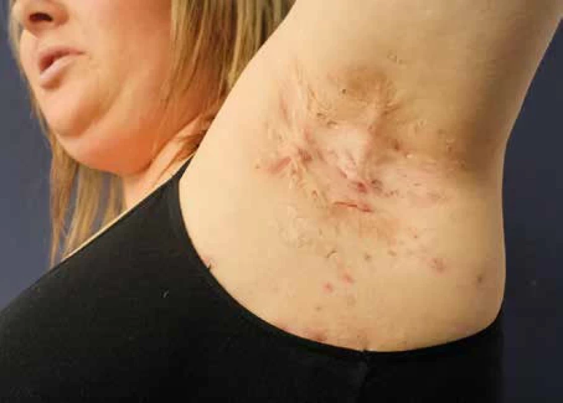 Hidradenitis suppurativa, stage II podle Hurleyho. [Foto: fotoarchiv Dermatovenerologické kliniky 2. LF UK, Fakultní nemocnice Bulovka]
