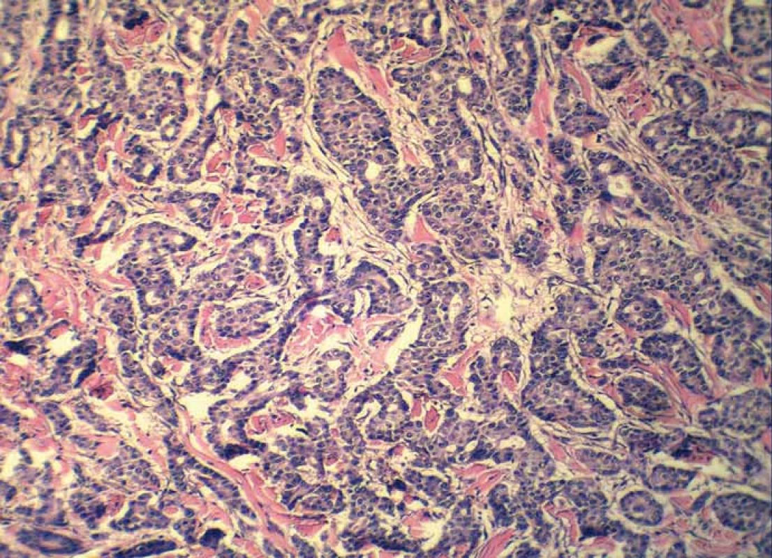 Detail on tubuloglandular microarchitecture of adenocarcinoma (hematoxylin and eosin, magnification 200×).