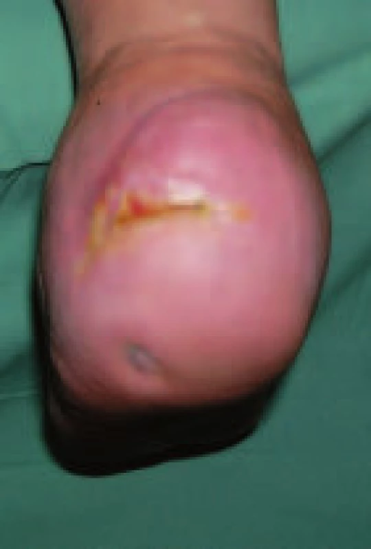 Zhojení defektu po 4 měsících léčby preparátem Hyiodine®.