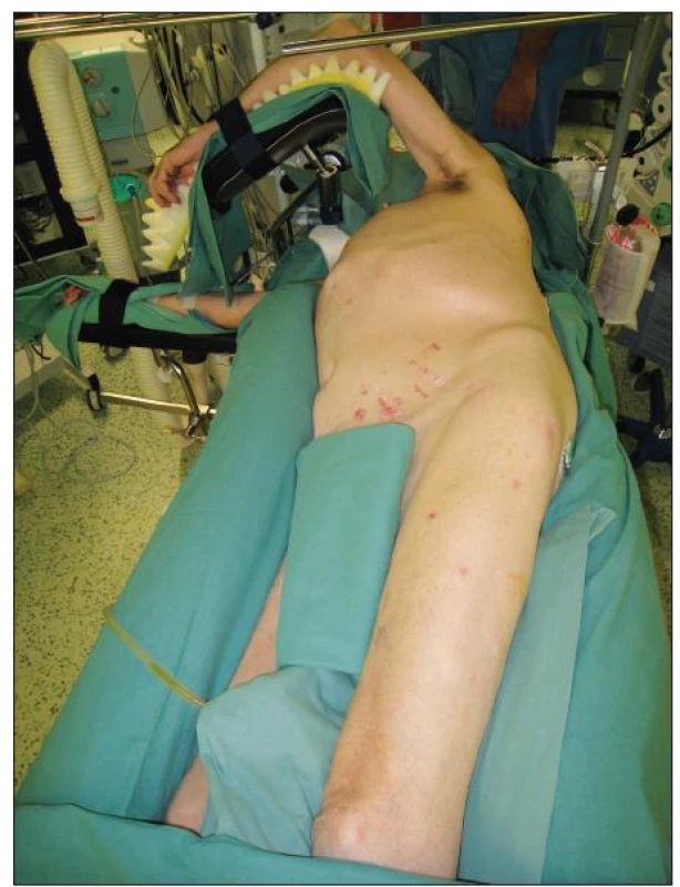 Poloha pacienta při operaci TAAA
Fig. 2. Patient position during TAAA procedure