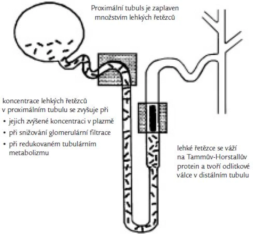 Princip vzniku odlitkové neuropatie, a tím renálního selhání s retencí dusíkatých látek.