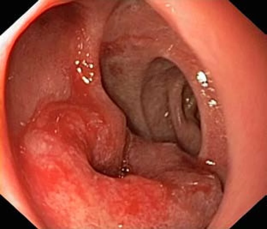 Metastáza maligního melanomu v bulbu duodena, tzv. bull’s eye appearance.
Fig. 1. Metastasis of malignant melanoma in the duodenal bulb – bull’s eye appearance.