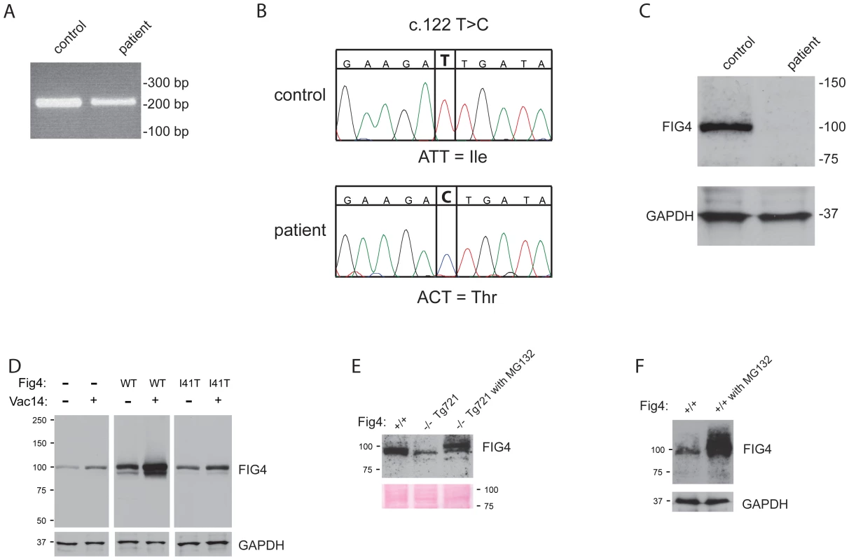 <i>FIG4</i> transcript and protein in CMT4J patient fibroblasts.