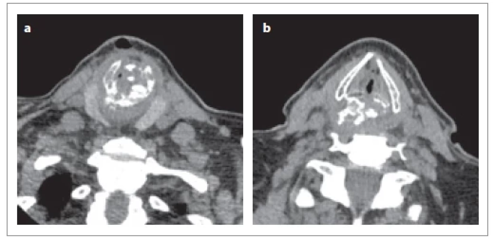 CT zobrazenie krku (axiálne rezy): a, b) intraluminálna expanzia v oblasti prstienkovej chrupky s početnými kalcifi káciami.CT scan of the neck (axial sections): a, b) intraluminal expansion in the region
of the annular cartilage with numerous calcifi cations.