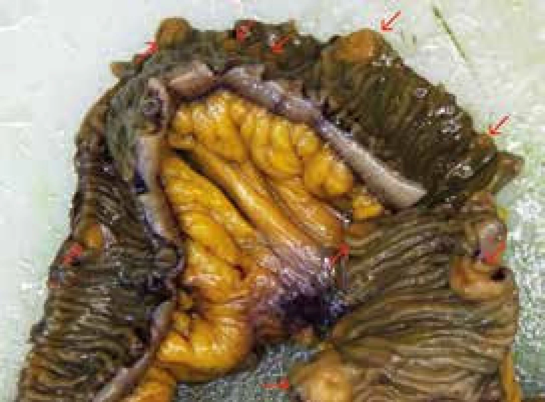 Specimen of ileum after fixation in formaldehyde.
Lesions of NET marked by arrows