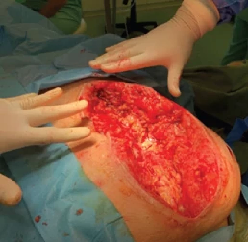 Odstranění nekrotických tkání a koagul k dosažení čisté a dobře prokrvené spodiny rány. Fig. 2. Removal of necrotic tissue and coagula to achieve a clean and well-perfused wound bed.