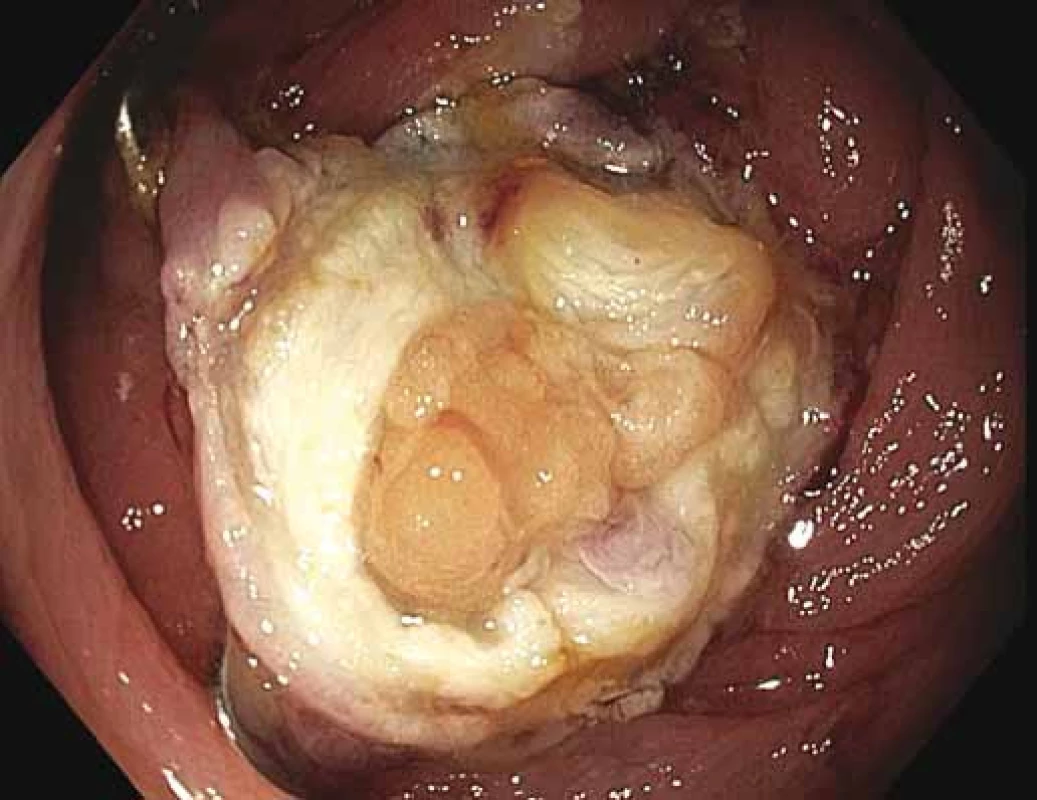 „Příznak terče“ v místě po provedené FTR.
Fig. 7. “Target symptom” in the location of the full-thickness resection.