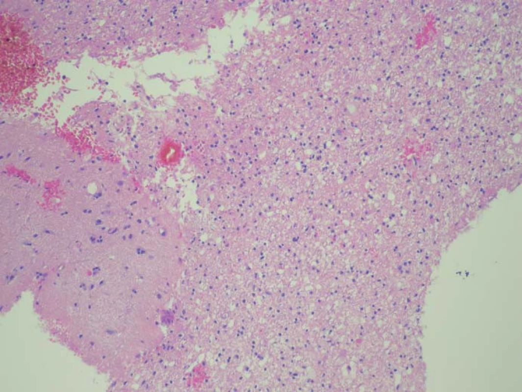 Histologický preparát ze zóny se slabší intenzitou fluorescence.
Nádorové elementy infiltrují parenchym mozku, stupeň infiltrace 50 %.
Fig. 2. A histological slide from the low fluorescence intensity zone.