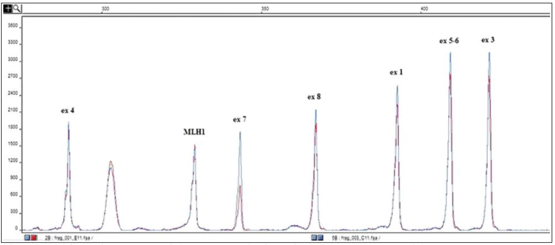 Výsledek molekulárně genetického vyšetření – detekce velké delece v genu pro C1 inhibitor (SERPING1).