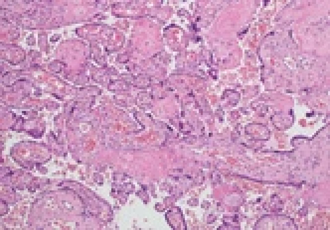 Histological section of the placenta demonstrated chorionic villi morphologically of the third trimester, hypercapillarization of the terminal villi, and presence of immature intermediate villi. Nodes and syncytial bud formation, as per hypoxic suff ering. A single focus of villus intervillositis was highlighted (VUE ungradable – possible low-grade). Three-vessel umbilical cord with focal Wharton's jelly edema.