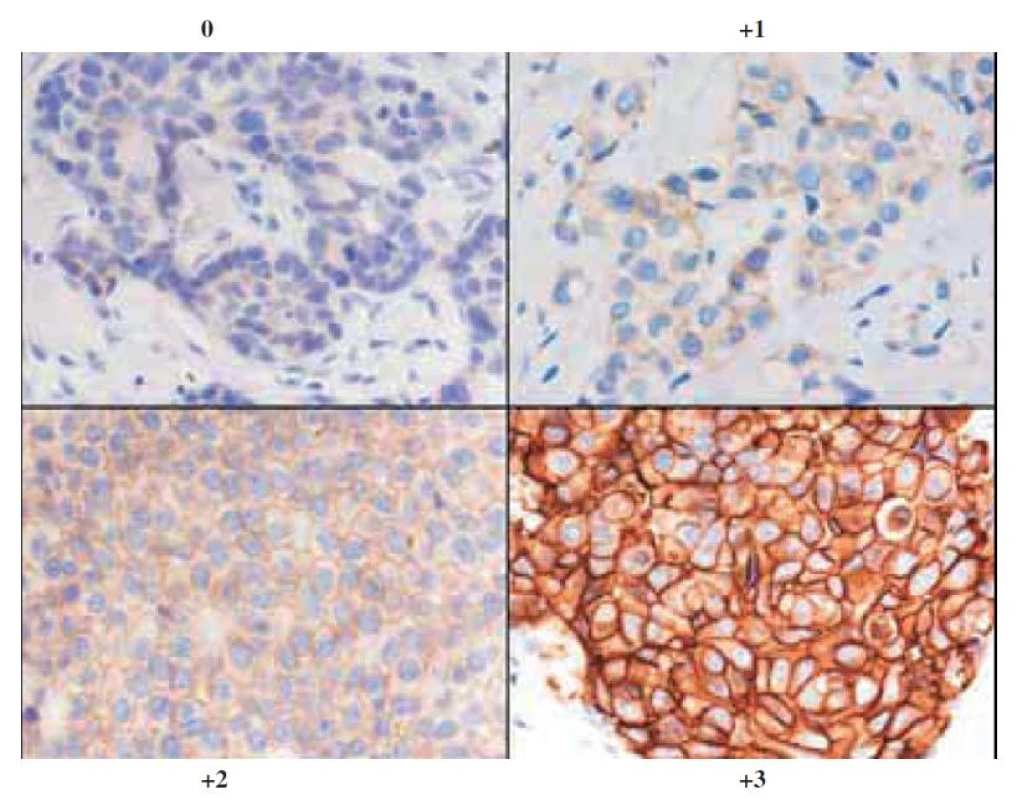 Typické obrazy exprese 0, 1+, 2+ a 3+. (dle www.patologie.info.cz)