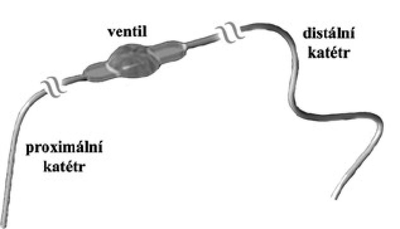 Základní tři části shuntu: proximální a distální katétr a ventil.