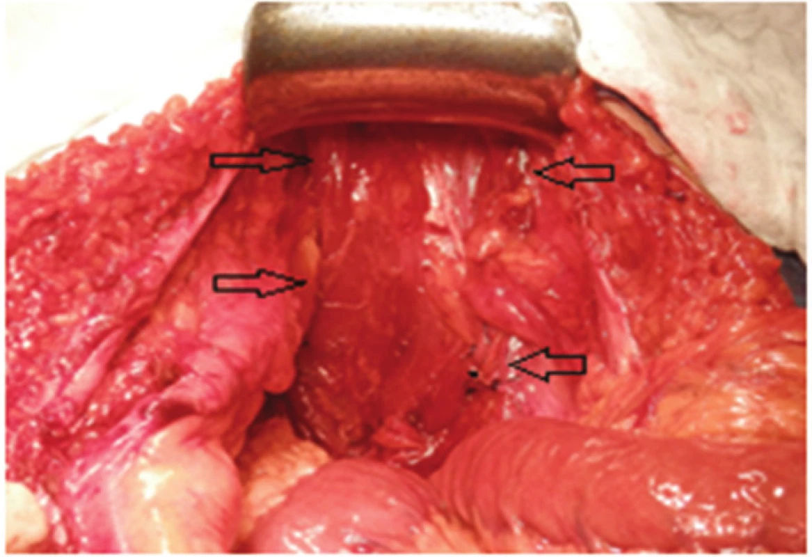 Pánevní vchod je zcela vyplněn svalovým lalokem
Fig. 7: Pelvic inlet filled completely by the muscle flap