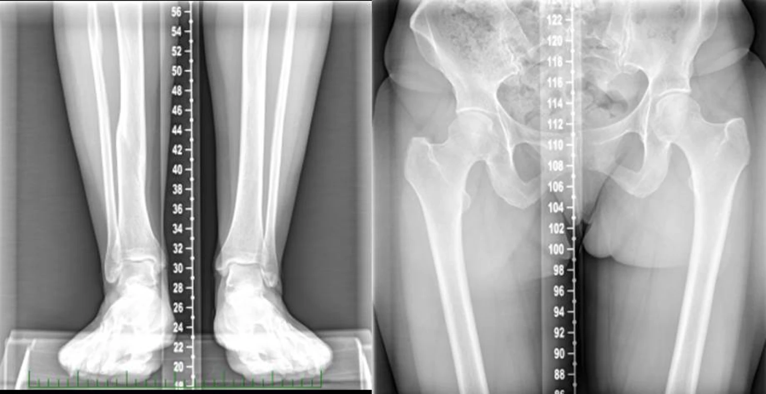Rtg nález před abreviační Z-osteotomií tibie