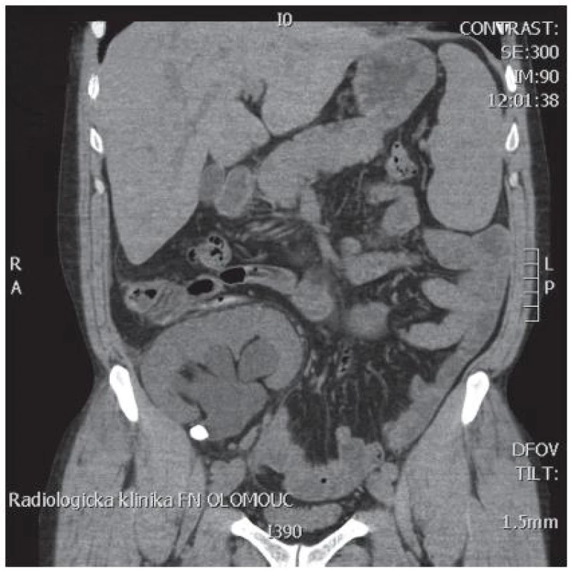 Nativní spirální CT transplantované ledviny s litiázou v pelviureterální junkci
Fig. 1. Native spiral CT scan of tranplanted kidney with stone in ureteropelvic junction