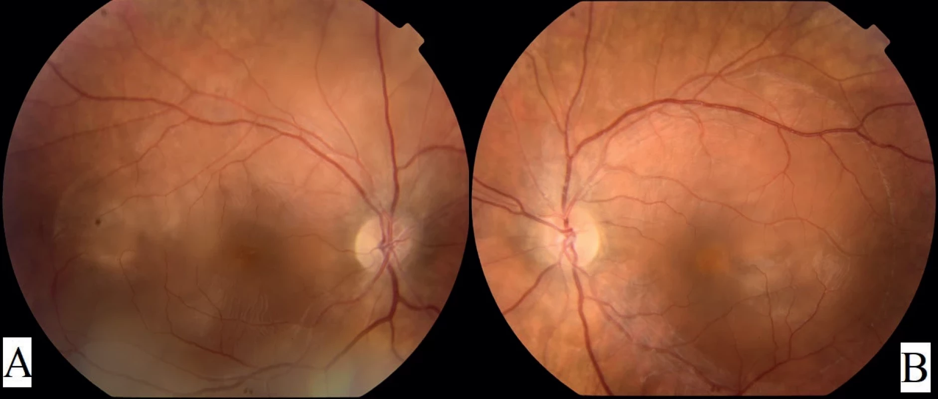 Fundus photographs of the right (A) and left (B) eye at the time of diagnosis of exudative retinal detachment. The exudative
retinal detachment in the right eye involves the macula and extends beyond the temporal vascular arcades, whereas in the left eye, the
detachment does not exceed the temporal arcades
