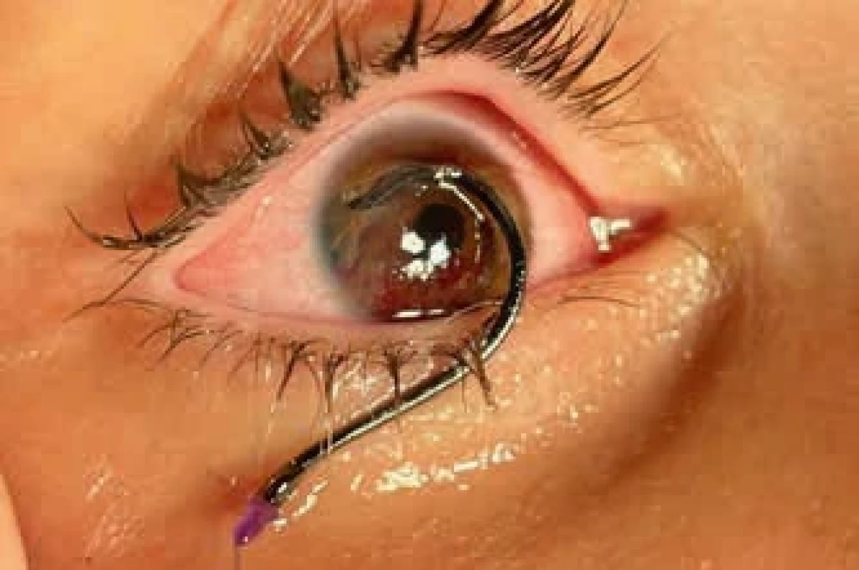 Perforace rohovky rybářským háčkem. Corneal perforation caused by a fishing hook.