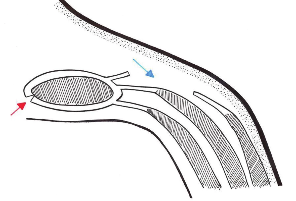 Separace komponentů − schéma
Modrá šipka přední komponent separace (aponeuróza m. oblq. ext.), červená šipka zadní komponent separace (zadní pochva m. rectus abd.)
Fig. 6: Component separation − scheme
Blue arrow anterior component separation (aponeurosis m. oblq. ext.), red posterior component separation (posterior sheath of m. rectus abd.)