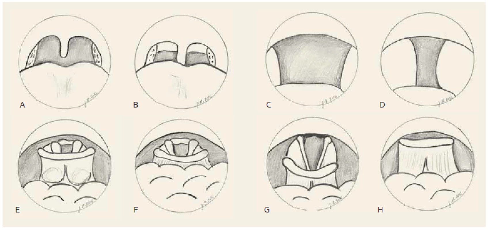 Hodnocení horních cest dýchacích v bdělém stavu.
Měkké patro, hodnoceno pohledem enorálně. Normální nález (A), zúžení – webbing zadních patrových oblouků, prodloužená uvula (B).
Orofarynx, hodnoceno endoskopicky transnazálně. Normální nález (C), zúžení – zúžení o > 50 % (D).
Kořen jazyka, hodnoceno endoskopicky transnazálně. Normální nález – valekuly viditelné (E), zúžení – valekuly překryté kořenem jazyka (F).
Hrtan/epiglottis, hodnoceno endoskopicky transnazálně. Normální nález (G), zúžení – epiglottis překrývá vchod hrtanu (H).
Velum, transoral view. Normal finding (A), obstruction – webbing of the posterior tonsillar pillars, elongated uvula (B).
Fig. 1. Evaluation of the upper airway during wakefulness.
Oropharynx, transnasal endoscopy. Normal finding (C), obstruction – obstruction of more than 50% (D).
Tongue base, transnasal endoscopy. Normal finding – complete view of valleculas (E), obstruction – valleculas not visible (covered by the tongue base) (F).
Larynx/epiglottis, transnasal endoscopy. Normal finding, full view of the vocal cord (G), obstruction – epiglottis covering the vocal cord, glottis opening not seen (H).