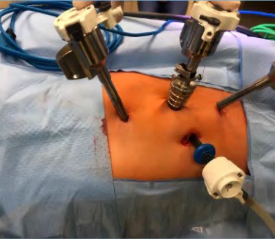 Umístění tří robotických troakarů u malých dětí spolu s jedním asistenčním portem. Fig. 2. Placement of three robotic trocars in small children, together with one assistant port. 