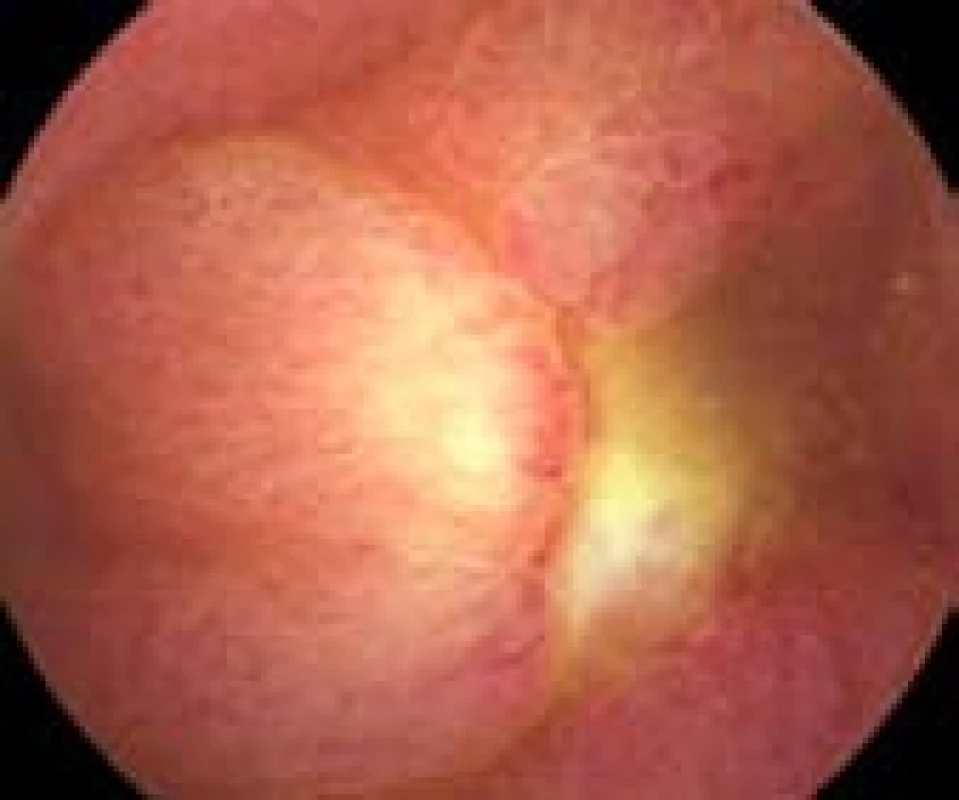 Hluboká ulcerace v ileu.
Fig. 2. Deep ulceration of the ileum.