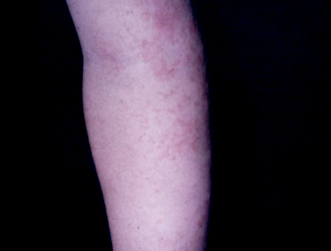 APEC syndrome, 5-ročné dievča (Mycoplasma pneumoniae)