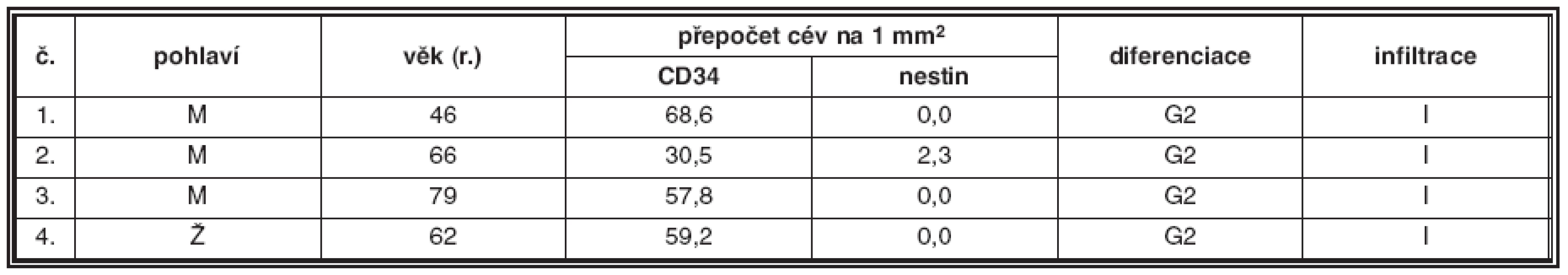 Plazmocytární myelom G2, intersticiální infiltrace