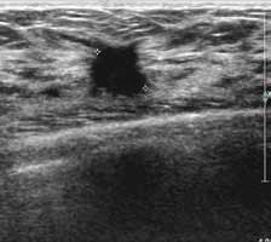Neostře ohraničené ložisko výrazně hypoechogenní s jemným akustickým stínem – histologicky invazivní duktální karcinom grade 3.