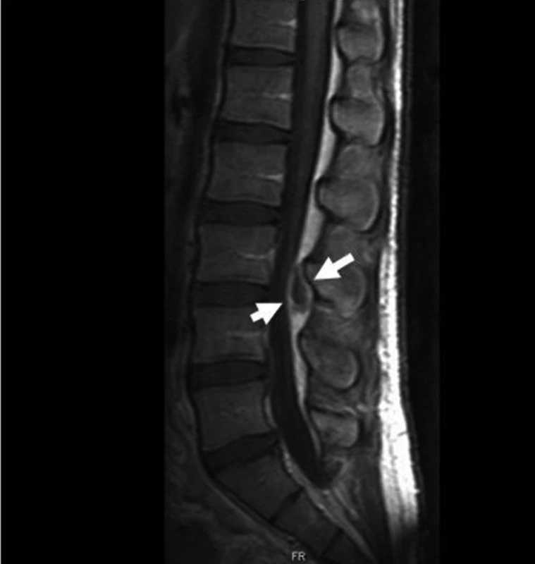 Vstupní MR: ložisko SEA (3. den ATB léčby).
Fig. 2. Entry MR: SEA focus (3rd day of ATB therapy).