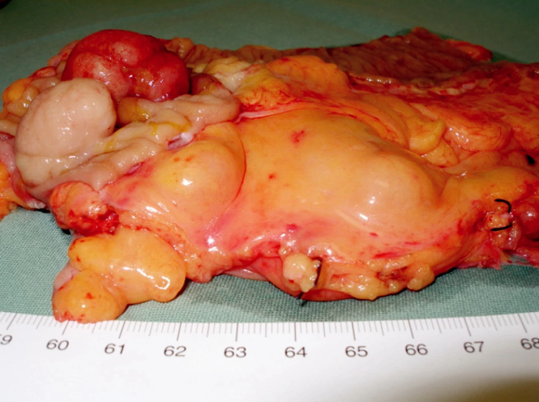 Resekáty rekta a pravé poloviny tračníku: patrny objemné lymfomy, mezokolon vzestupného tračníku masivní infiltrace uzlin
Fig. 5. Specimens with rectal and caecal lymphoma; massive mesenteric lymh node infiltration is remarkable