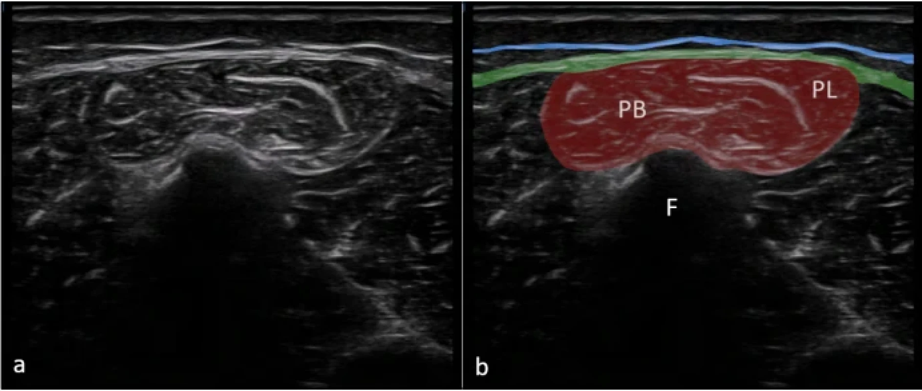 Zobrazení fascia cruris v lokalizaci lateral na nativním sonografickém snímku (a) a na barevně zvýrazněném sonografickém snímku (b). Superficiální fascie je znázorněna modrou linií. Hluboká fascie (zelená linie) přechází přes peroneální svaly.  Fig. 9. Imaging of the crural fascia in the lateral location in the original ultrasound image (a) and in a color-enhanced ultrasound image (b). The superficial fascia is represented by a blue line. The deep fascia is represented by a green line over the peroneal muscles. 