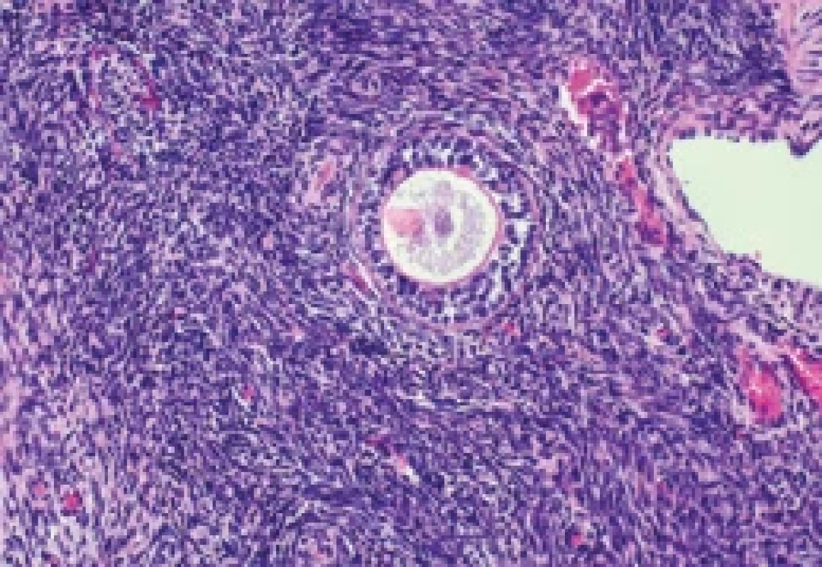 a. Histologický řez kortikální tkáně vaječníku před zamražením – sekundární folikl (barevní HE, 200×). Fig. 11a. Histological section of ovarian cortical tissue before cryopreservation – secondary follicle (HE staining, 200×). HE – hematoxylin a eozin