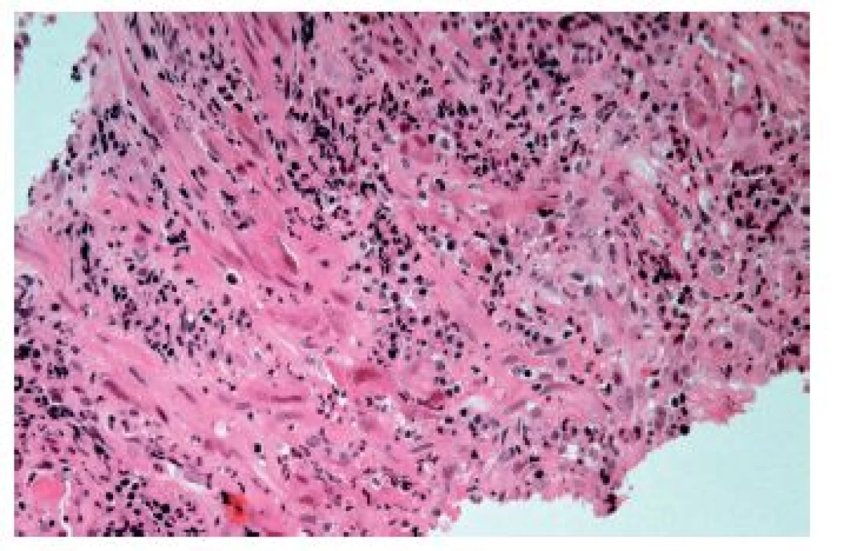 Cytomegalovirová ezofagitida. Charakteristické intranukleární eozinofilní (modrá šipka) a méně nápadné intracytoplazmatické bazofilní inkluze se nacházejí zejména 
v endoteliích, myofibroblastech a makrofázích ve spodině ulcerací (HE, 800x).