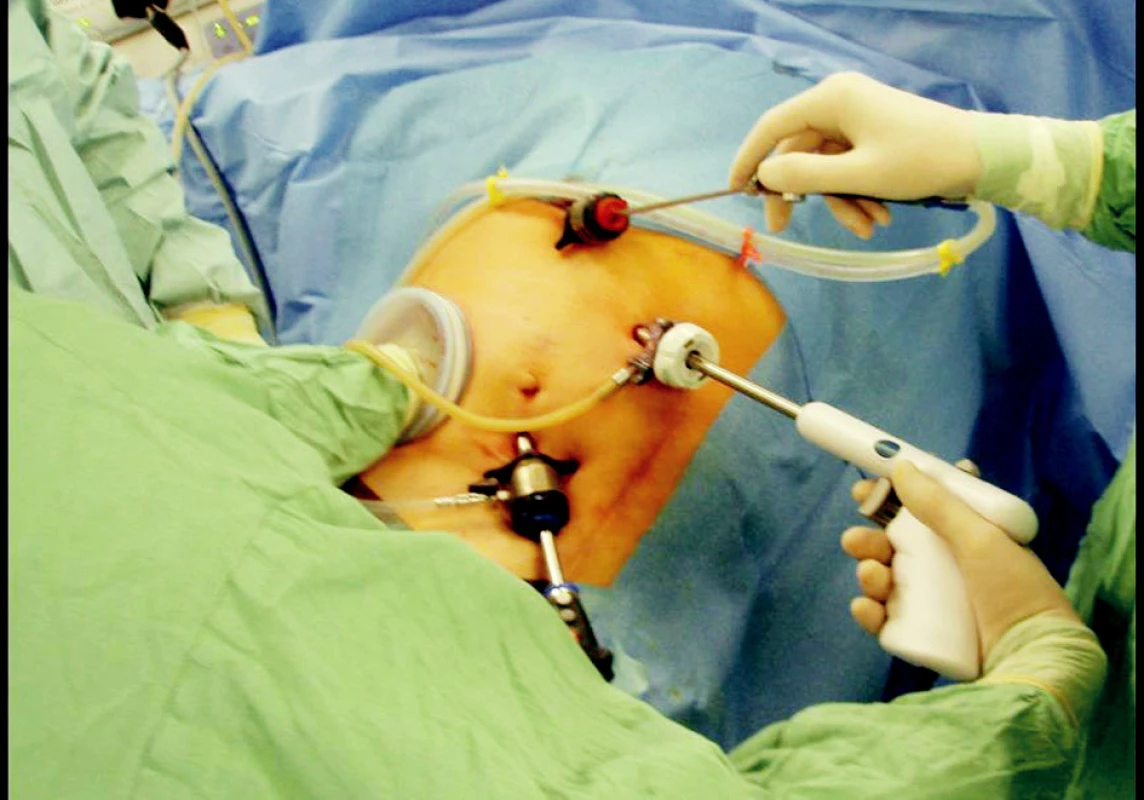 Peroperační snímek umístění pracovních trokarů a LapDiscu
Fig. 3. A peroperative view of in- use throcars and a LapDisc