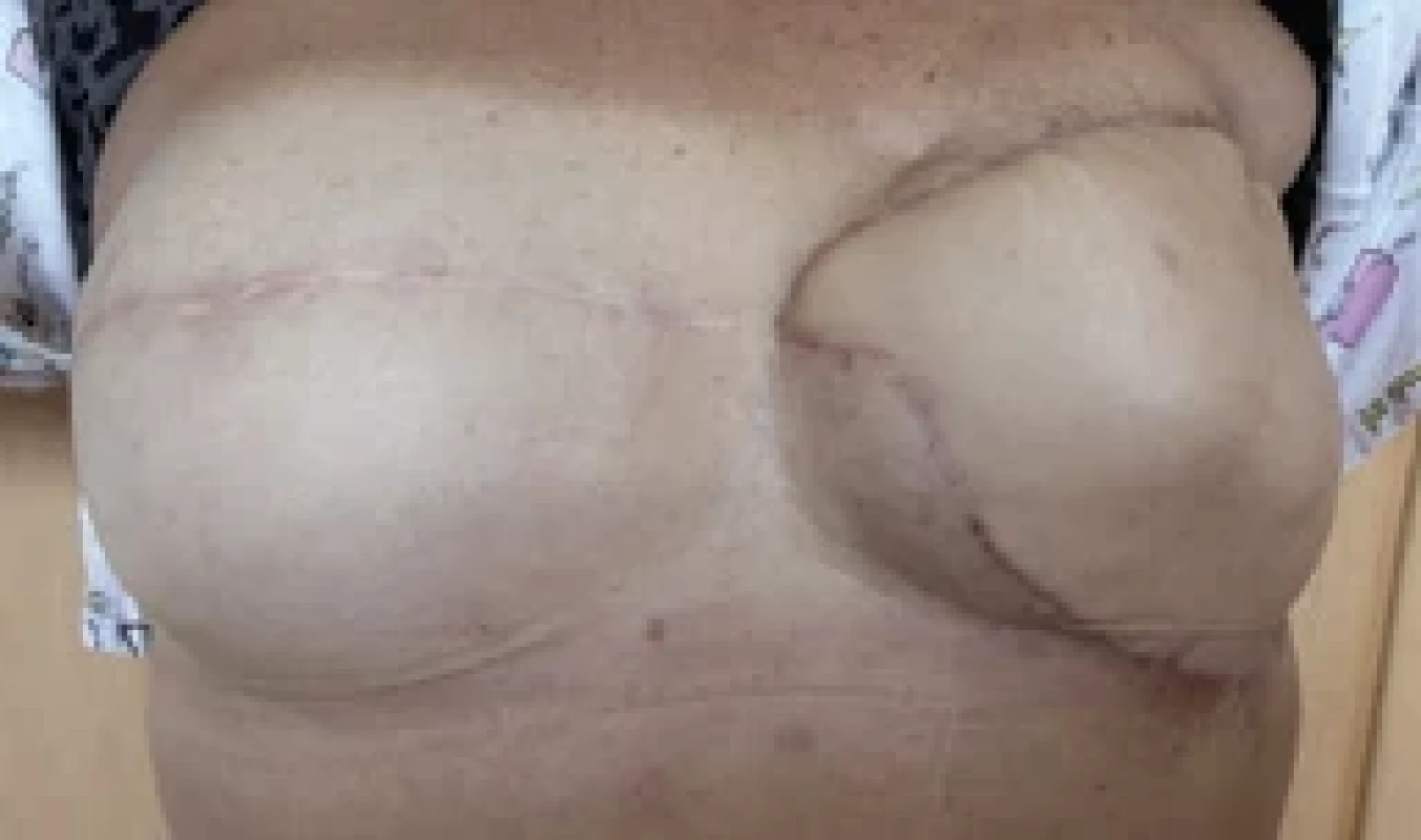 Final outcome after transverse rectus abdominis myocutaneous (TRAM) fl ap reconstruction performed at another institution.
