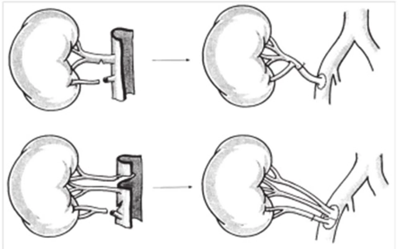 Kombinované rekonštrukčné techniky [11]
Fig. 5: Combined reconstruction techniques [11]