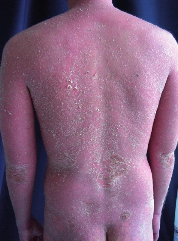 Psoriasis vulgaris generalisata po vysazení cyklosporinu A