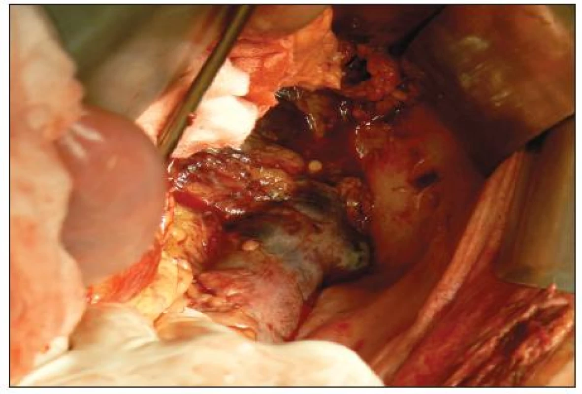 Transmurálna nekróza lienálnej flexúry
Fig. 1. Transmural necrosis of lienal flexure