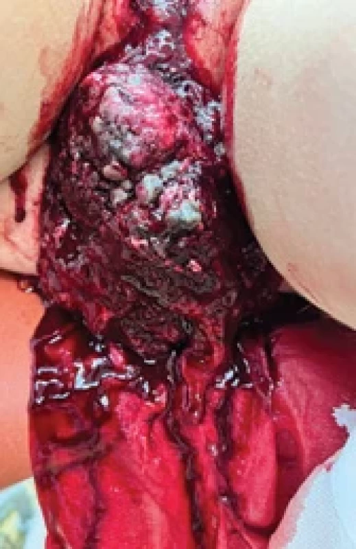 Tumor prolabující zevně před pochvu (fotografi e z archivu MUDr. Turekové). 