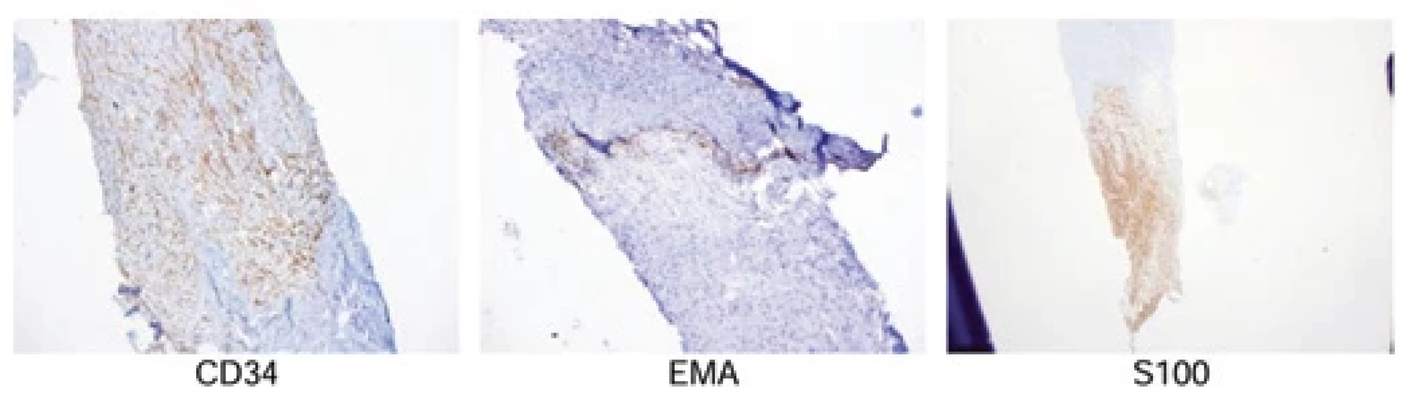 Immunohistochemistry of the tumor showing positivity for CD34, EMA, S100.