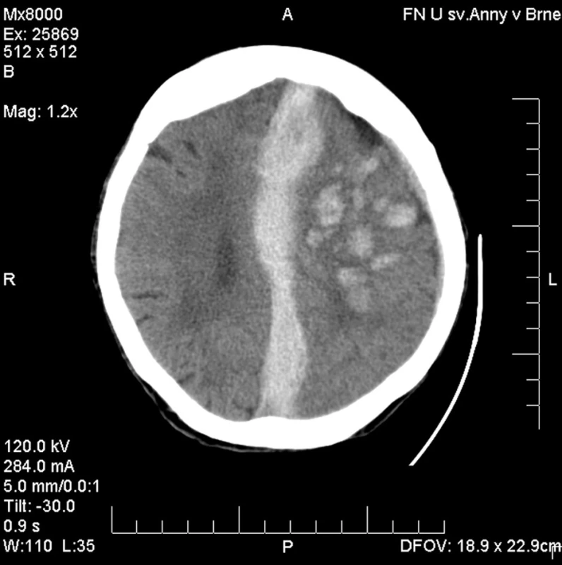 Rozvoj žilní trombózy po evakuaci interhemisferického subdurálního hematomu s fudroyantním průběhem
Fig. 4. Development of cerebral venous thrombosis after interhemispheric subdural haematoma evacuation with fudroyant clinical course