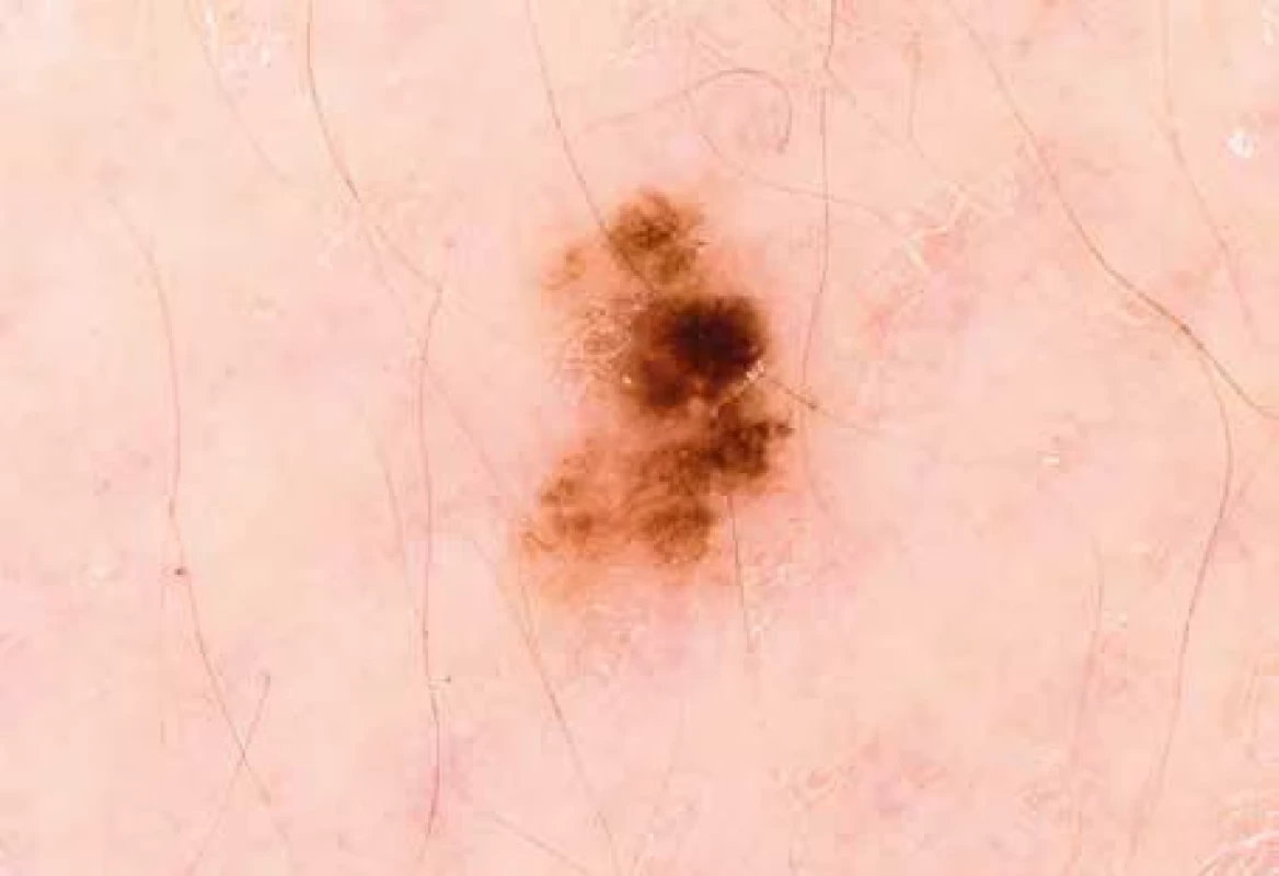Dermatoskopický obraz: melanoma in situ, léze o velikosti 5 × 4 mm.