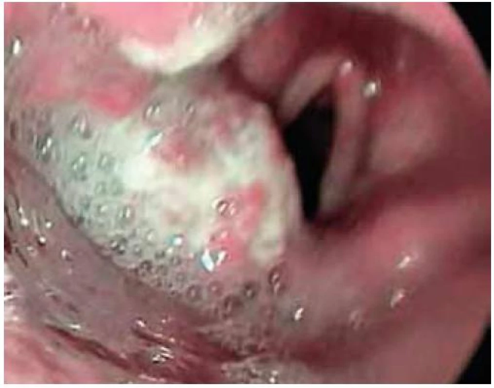 Pokročilý karcinom hrtanu vlevo.
Fig. 3. Advanced carcinoma of the left larynx.