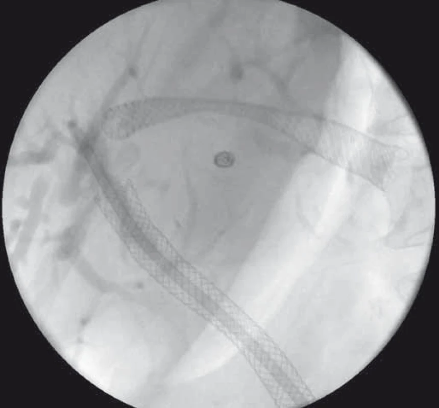 EUS-HGS – transgastricky zavedený SEMS v ľavom ductus hepaticus.
Fig. 6. EUS-HGS – transgastrically deployed SEMS in the left hepatic duct.