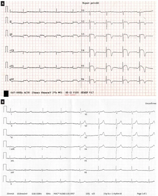 Electrocardiograms of the patient. (A) ECG of the patient on presentation with dyspnoea (as described in the text), showing ST--elevation, compatible with ST-elevation myocardial infarction; (B) ECG obtained 20 months earlier, showing only sinus bradycardia. Electrocardiograms of the patient. (A) ECG of the patient on presentation with dyspnoea (as described in the text), showing ST--elevation, compatible with ST-elevation myocardial infarction; (B) ECG obtained 20 months earlier, showing only sinus bradycardia. 