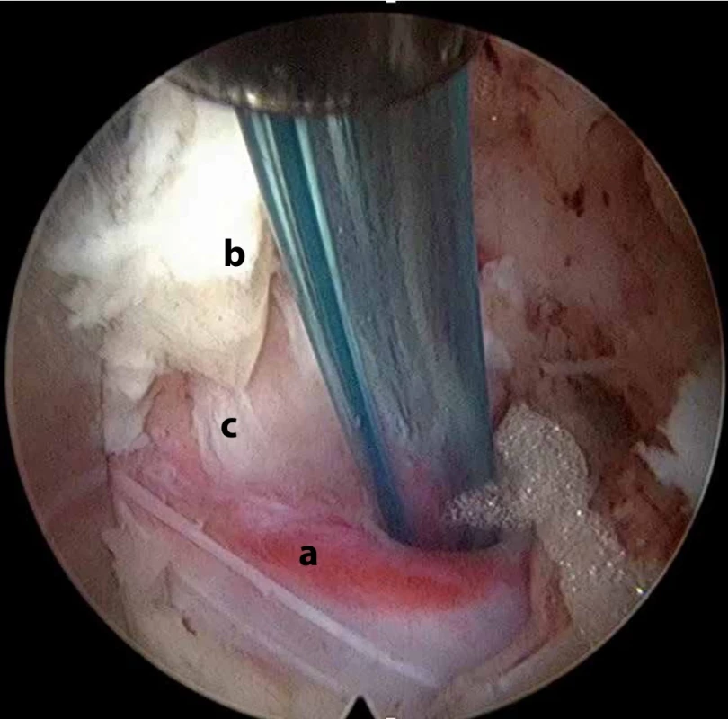 Translaminární endoskopický přístup a – odstupující nervový kořen, b – ligamentum flavum,  c – sekvestr ploténky