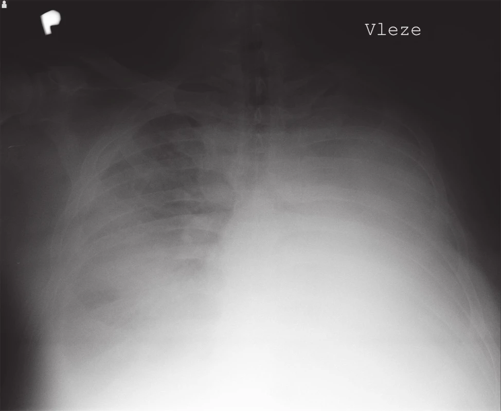 Prostý snímek hrudníku vleže zobrazující zastřený levý hemitorax
Fig. 1: Plain chest x-ray in supine position showing a blurred left hemithorax